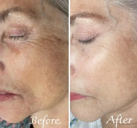 Patient before and after 3 treatments at IRIS Aesthetics: Custom Facial, Microneedling, and Chemical Peel