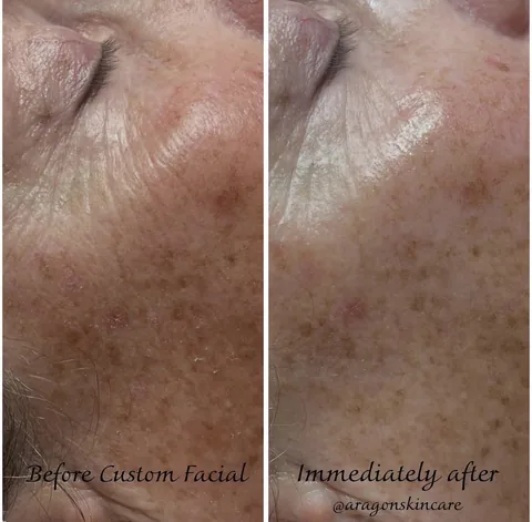 Patient before and after Custom Facial treatment at IRIS Aesthetics