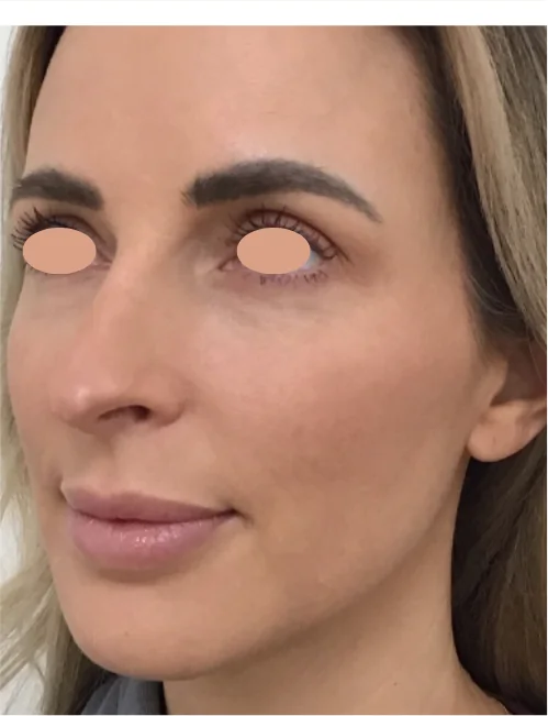 Patient after Facial Series showing healthy, radiant complexion