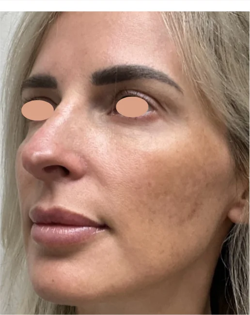 Patient before Facial Series treatment at IRIS Aesthetics