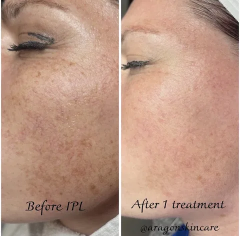 Patient before and after IPL Photofacial treatment at IRIS Aesthetics