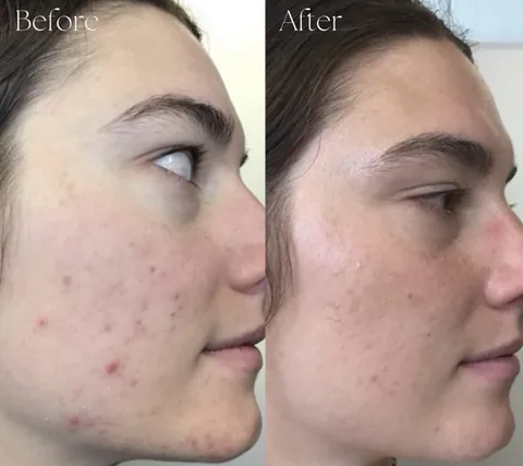 Patient before and after microneedling treatment for acne and breakouts at IRIS Aesthetics