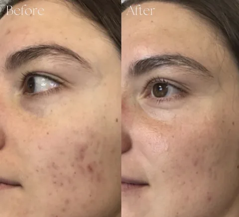 Patient before and after microneedling treatment for acne scarring at IRIS Aesthetics