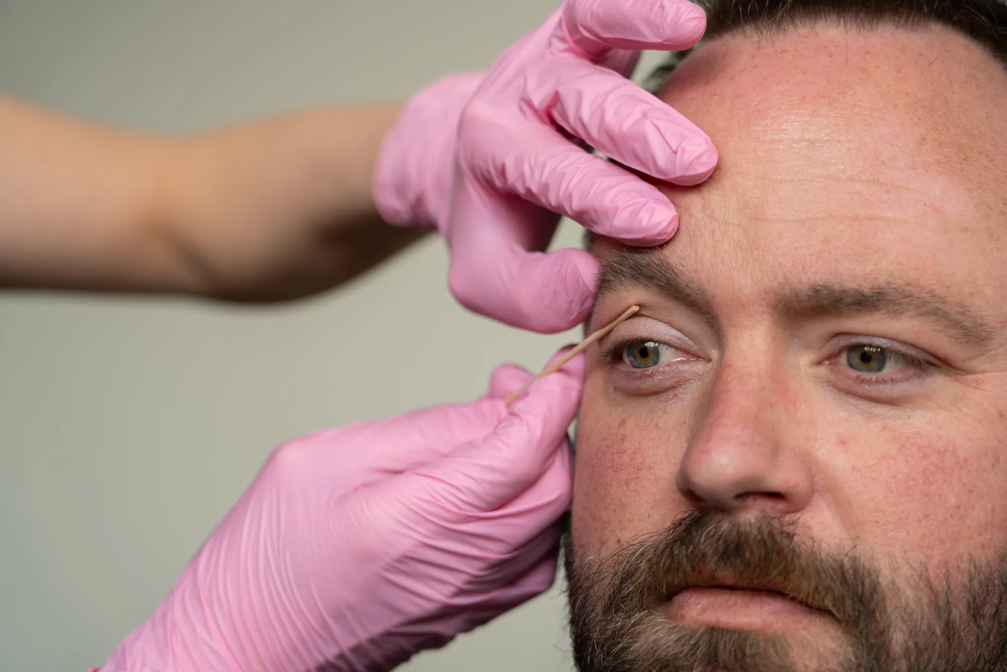 Eyelid surgery procedure at IRIS Aesthetics in Longmont, CO